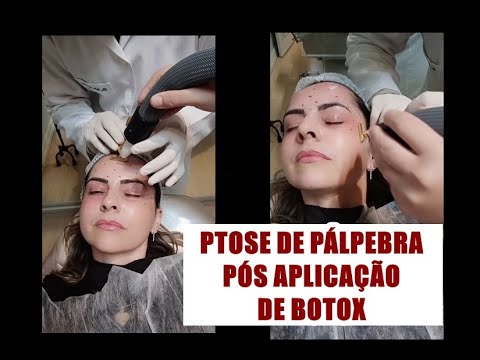 Vídeo: Pálpebra Caída Após Botox: Causas E Tratamento