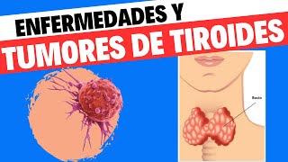 Thyroid gland pathology. Thyroid tumors and diseases.