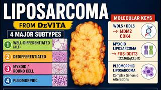 Liposarcoma