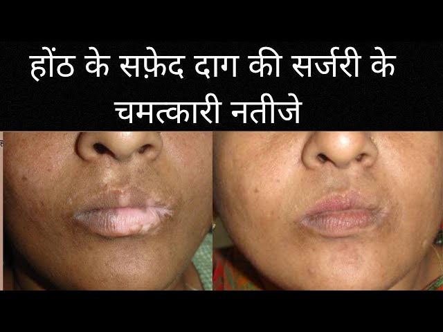 Amazing results of lip vitiligo surgery:स्किन ग्राफ़्टिंग द्वारा होठों के सफ़ेद दाग का स्थाई इलाज