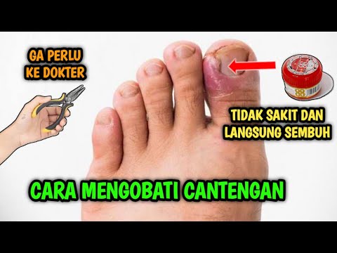 Video: Cara Mengeluarkan Kanta Sentuh dengan Kuku: 10 Langkah