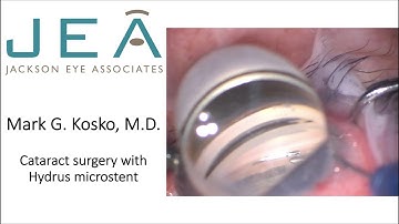 cataract surgery with hydrus microstent kosko