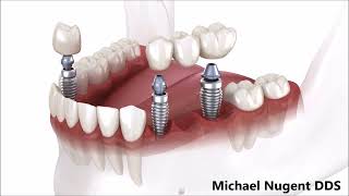 Single or Multiple Teeth replacement with Dental Implants