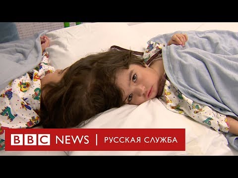 Видео: Сиамские близнецы считаются одним человеком?