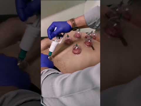Islamic Hijama Session — Demonstration