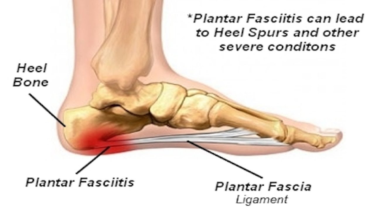 How To Get Rid Of Plantar Fasciitis Permanently 5 Home Remedies