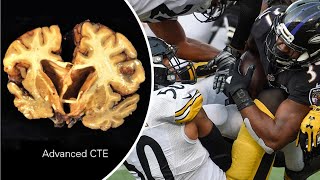 NFL concussions: 96% of former NFL players tested had CTE brain disease - Compilation