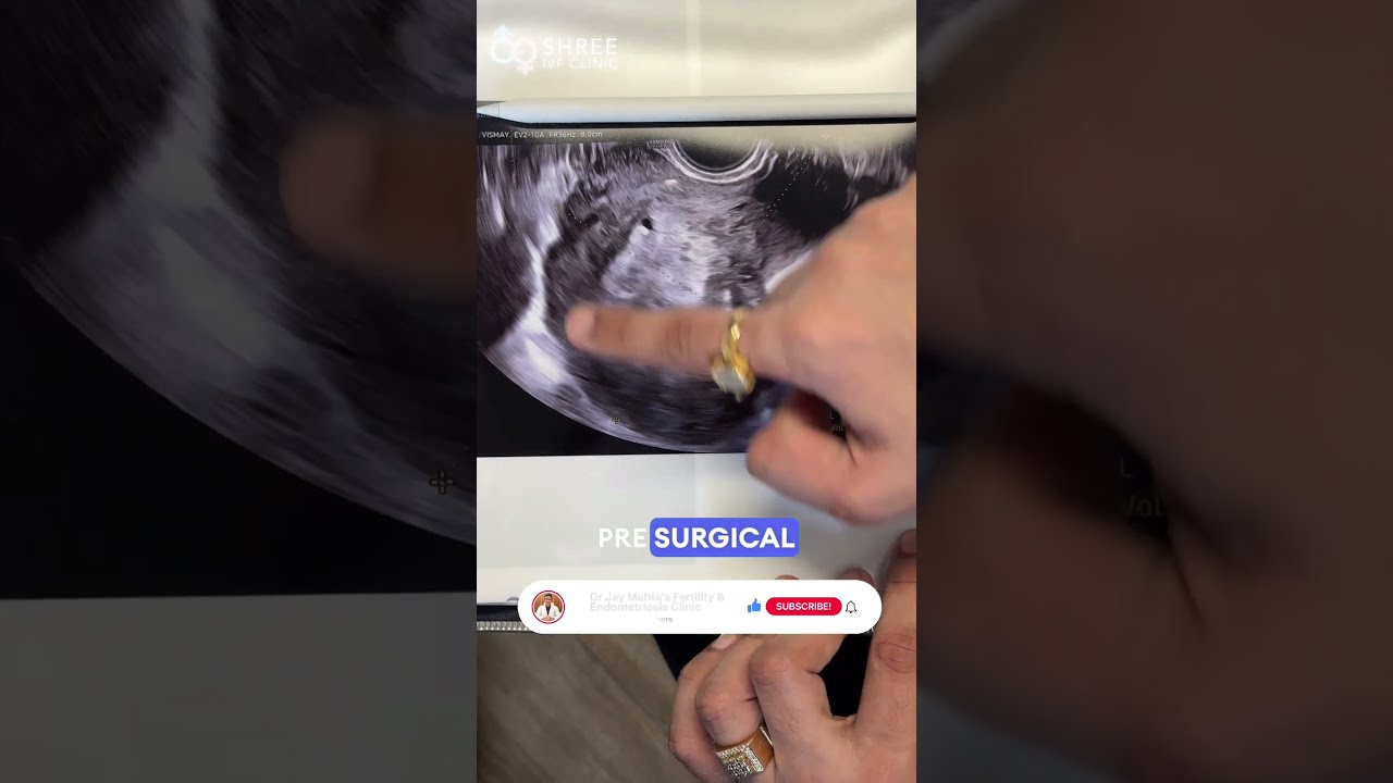 Microwave Ablation For Adenomyosis 50 Uterus Shrinkage In Just 3 Months Dr Jay Mehta