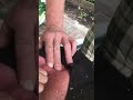 Satisfying Giant Pimple Extraction