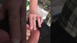 Satisfying Giant Pimple Extraction