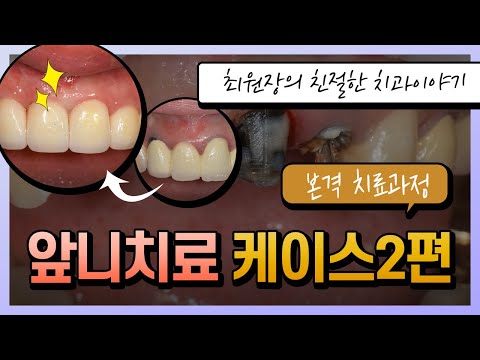 <strong>앞니치료</strong> 두번째 이야기입니다. 복잡한 치료과정을 통해 완성까지 진행했습니다.