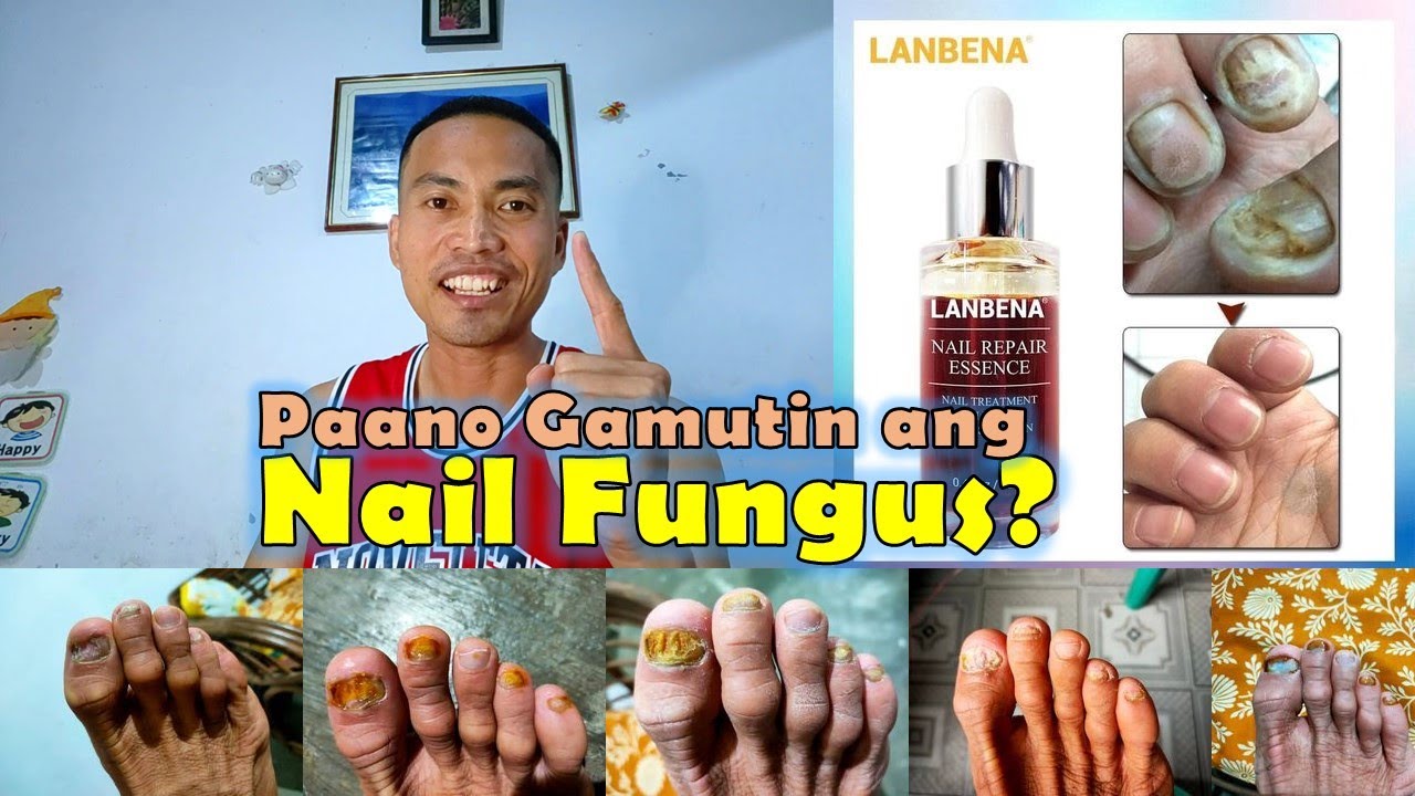 Solusyon sa Nail Fungus Lanbena Nail Repair Essence Review YouTube