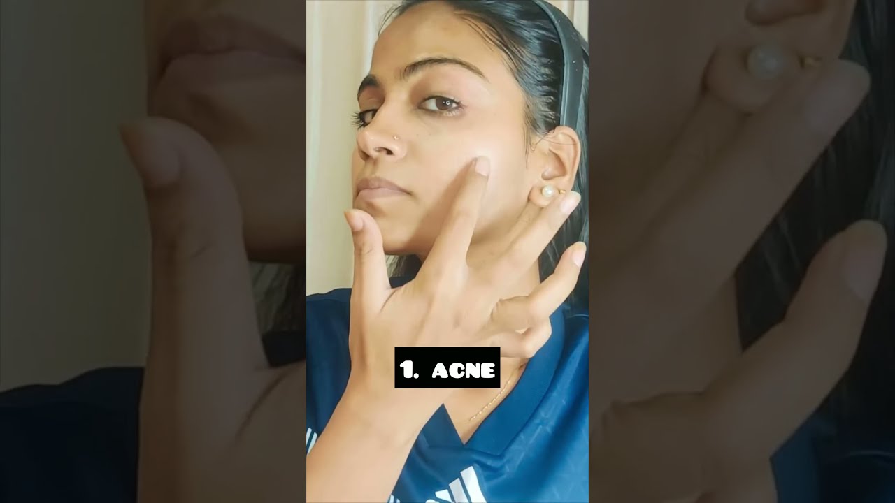 Day 183 Uses of Aziderm Cream 20% 