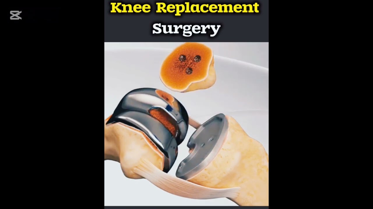 Total Knee Replacement Surgery 3D AnimationI 3D Animation of a Knee Replacement | JointReplacement