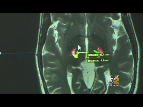 New Non-Invasive Procedure