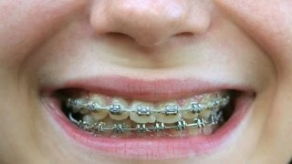 Did Humans ALWAYS Suffer from Crooked Teeth? (The History of Braces)