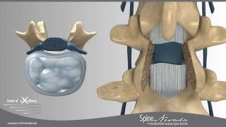 Lumbar Laminectomy and Fusion Presented by Swift Institute, Reno Spine Surgeons and Spine Center