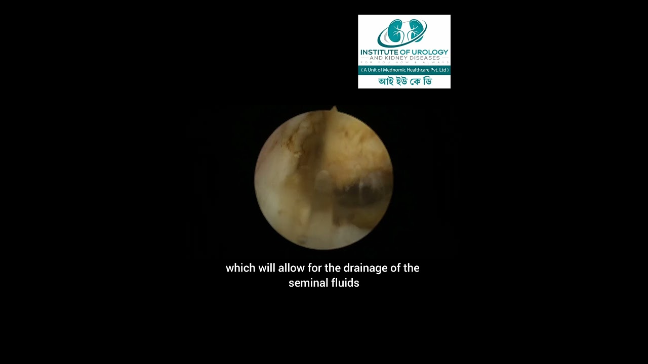 Overcoming Ejaculatory Duct Obstruction 