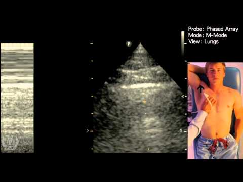 M-Mode for Lung Sliding