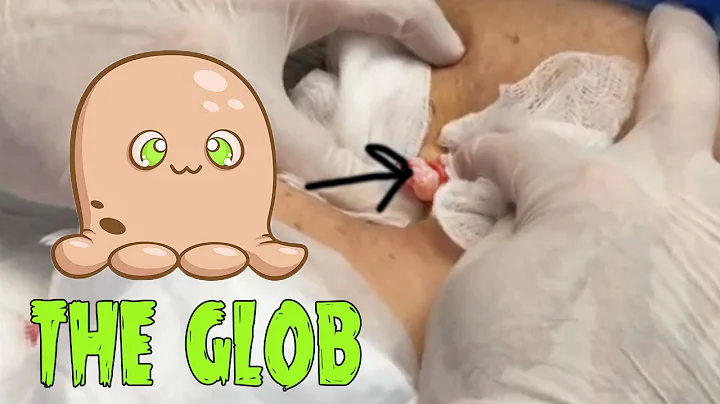 Squishy Shoulder Cyst - Release the Glob