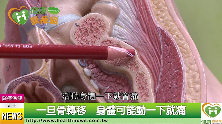 以為骨刺痛　結果竟是攝護腺癌骨轉移 - 天天要聞