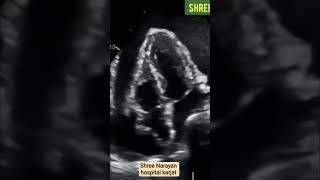 Massive #pericardialeffusion #echocardiography #cardio