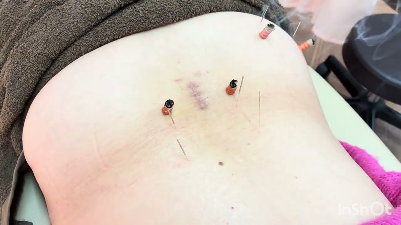 70代女性　主婦　脊柱管狭窄症の手術経験あり　腰の痛みがあり来院　今では卓球できるようになった♫鍼灸してみた|【宝塚市】おかだ鍼灸整骨院