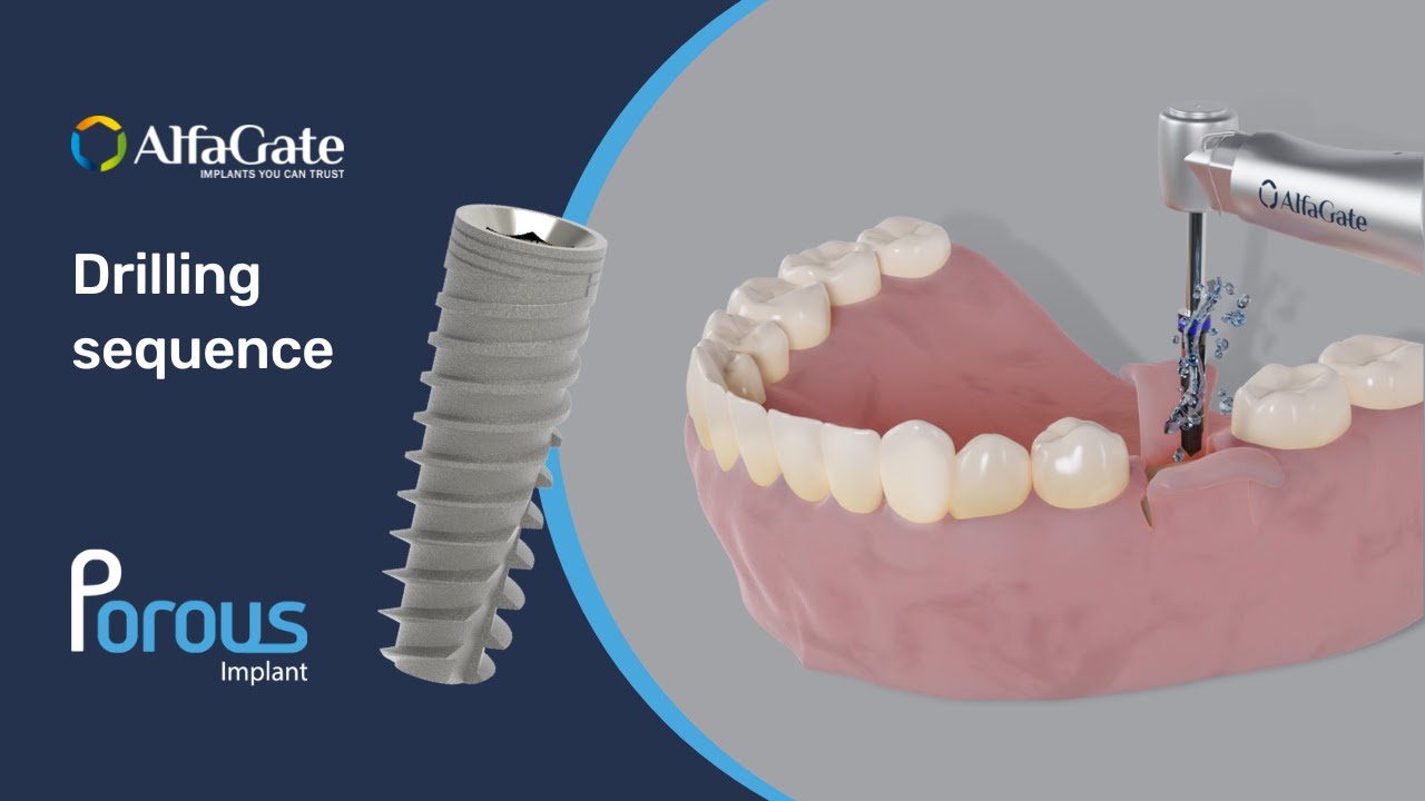 POROUS DENTAL IMPLANT.(SCIP) – Trios Implants