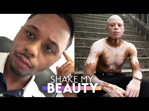 Acne Medication Gave Me Vitiligo & Alopecia | SHAKE MY BEAUTY 