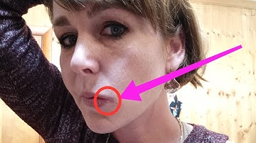 How to treat Angular Cheilitis FAST! 3 steps, 3 days!