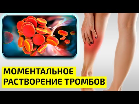 ТРОМБЫ в сосудах - Это знают только ФЛЕБОЛОГИ. 7 ПРОДУКТОВ Для Моментально Растворения ТРОМБОВ