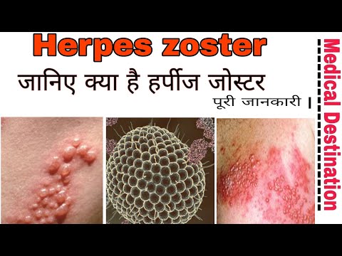 Video: Zhoster (kruid) - Nuttige Eigenschappen En Gebruik Van Zhoster, Zhoster Schors, Zhoster Fruit, Zhoster Tegen Herpes