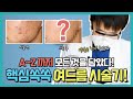 여드름피부관리✔️ 피부과 전문의가 말하는 여드름 치료의 핵심들!