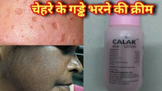 चेहरे के गड्ढे भरने की क्रीम | Best cream for skin problems | calak Lotion | Brijwasi Girl