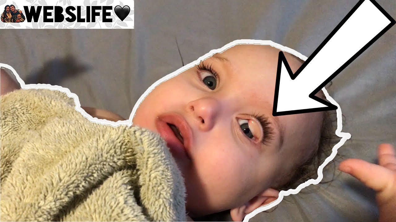 TERRIBLE BABY EYELID ACCIDENT! YouTube