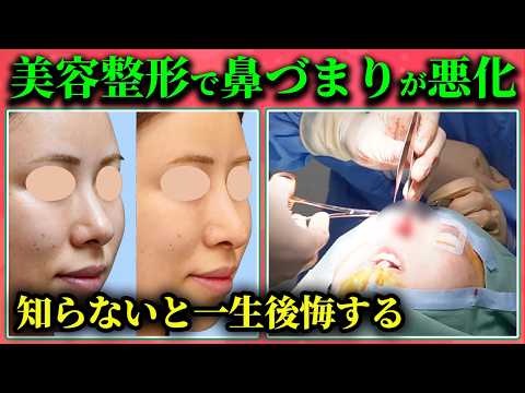 Septal Extension Rhinoplasty] We followed a surgical procedure