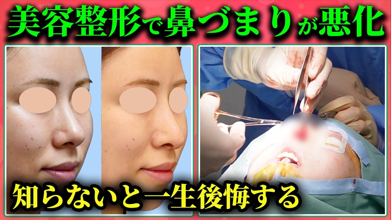Septal Extension Rhinoplasty] We followed a surgical procedure
