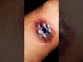 Why You Get a Bruise After a Shot | What Happens Inside Your Vein