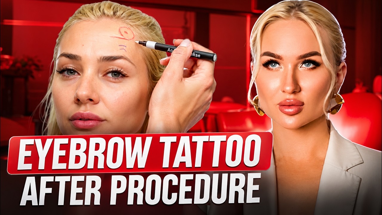 Botox. Drooping brows after injection - YouTube