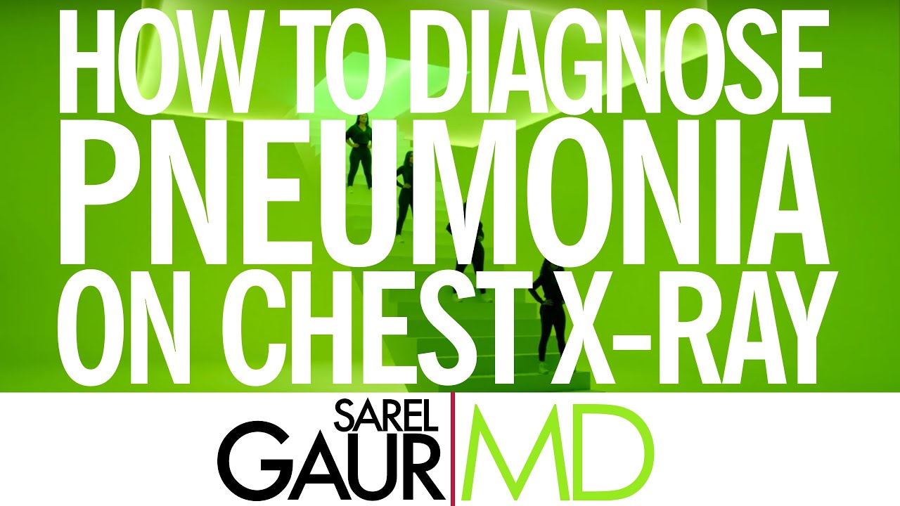 How to Diagnose Pneumonia on Chest XRay YouTube