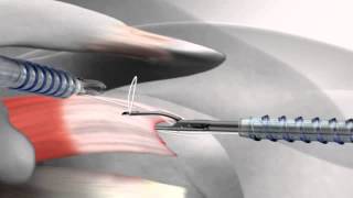Arthrex SutureBridge™ rotator cuff repair