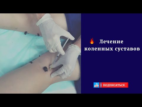 Лечение коленных суставов с помощью пиявок. Практическое занятие