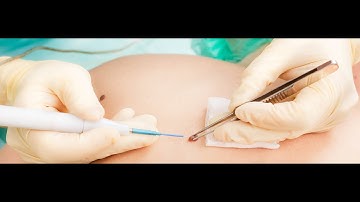 CPT code for Excision of lesion with closure - simplify medical coding