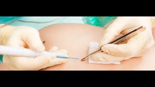 CPT code for Excision of lesion with closure - simplify medical coding
