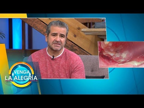 Vídeo: Càncer De Boca (Fibrosarcoma De Gengiva) En Gossos