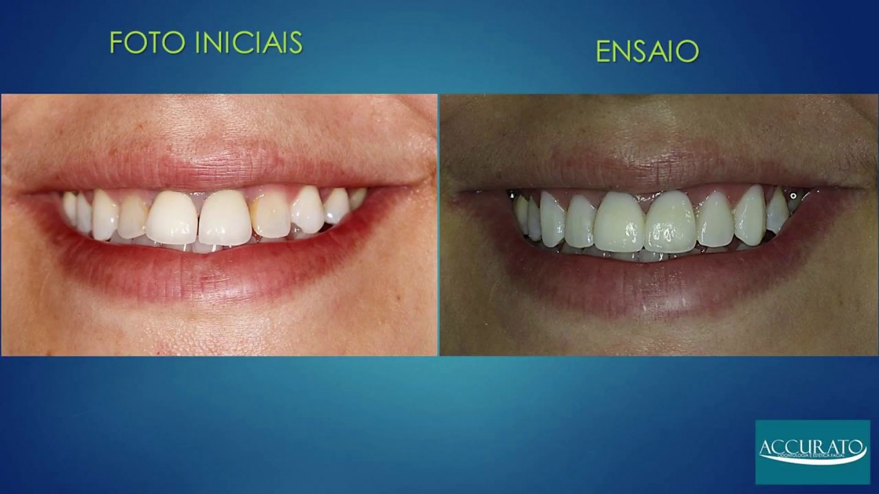 Passo A Passo Das Lentes De Contato Mockup Youtube