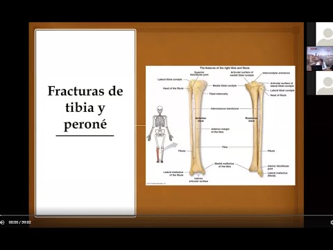Vídeo: Fractura De Tibia