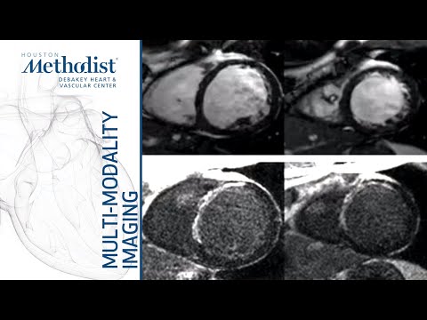 Video: Functional And Dysplastic Cardiopathy, Ischemic And Secondary