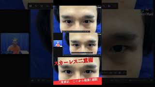 #二重修正 #スカーレス二重術 で #二重埋没 のような瞼の動きに変えた症例#形成外科医 が症例を解説します