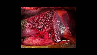 HCC Left Lobe of Liver  | Hepatectomy Surgery performed by Bharat Kumar Nara at Star Hospitals HCC